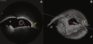 (A) Image obtained by optical coherence tomography at distal left main coronary artery bifurcation. (B) Three-dimensional reconstruction of the same region. Red arrows: irregular-bordered protruding image with high signal attenuation, compatible with calcium nodule; yellow arrow: contiguous typical calcified area (continues along the left anterior descending artery and left main coronary artery in the longview). O: left circumflex artery ostium; X: wire artifact.