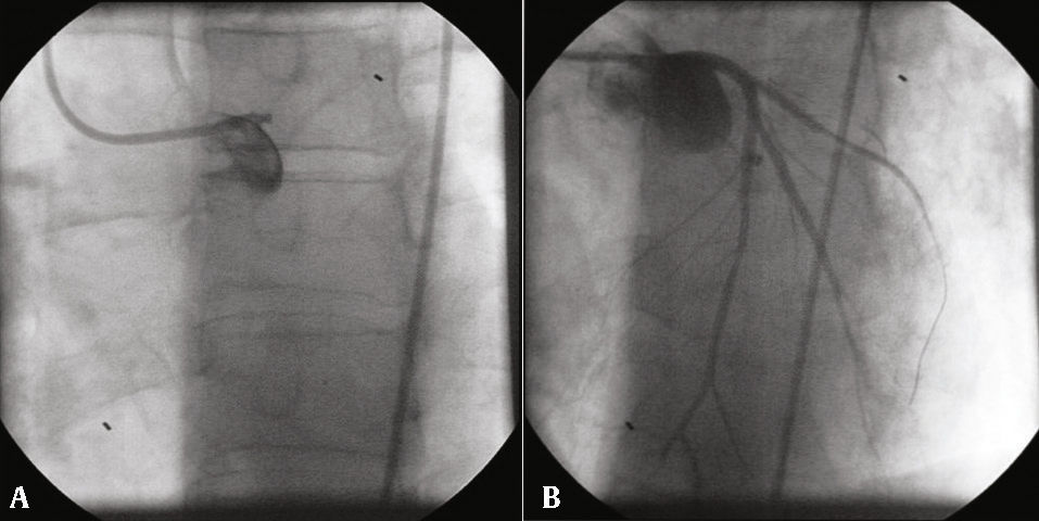 Left main coronary artery stent thrombosis | Revista Brasileira de ...