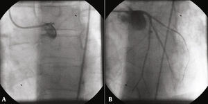 First percutaneous coronary intervention. (A) Occlusion of left main coronary artery; (B) final result with Thrombolysis in Myocardial Infarction (TIMI) 3 flow in both left anterior descending artery and left circumflex artery.