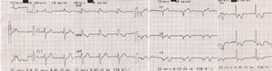 12-lead electrocardiogram at admission in the second myocardial infarction episode.