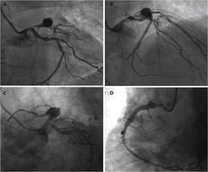 Coronary angiography of the left coronary artery in anteroposterior (A), right oblique cranial (B) and left oblique caudal views (C), and right coronary artery in left anterior oblique view (D).