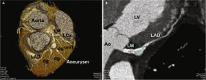 Pre-operative cardiac computed tomography showing 3D reconstruction (A) and detail of the left coronary artery (B). LM: left main; LAD: left anterior descending artery; LCx: left circumflex artery; dg: diagonal branch; om: obtuse marginal branch; LV: left ventricle; Ao: aorta.