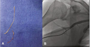(A) Tissue fragments removed after angiographic catheter washing. (B) Right radial arteriography showing the axillary origin of the right radial artery.