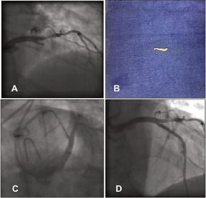 (A) Left coronary angiography showing left anterior descending artery proximal occlusion. (B) Tissue fragment removed from the left anterior descending artery by manual aspiration. (C) Left coronary angiography showing reperfusion of the left anterior descending artery after aspiration. (D) Control left coronary angiography after stent implantation.