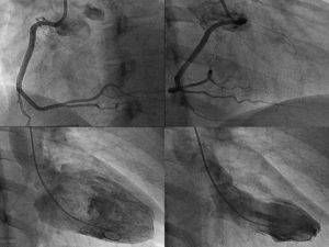 Upper panel: dominant right coronary artery with no lesions, in the left and right oblique views. Lower panel: left ventriculography in the right oblique view showing preserved contractile function.