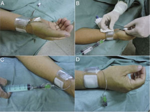 Placement of the hemostatic device: the device is placed approximately 1cm above the puncture site with balloon inflation using 15mL of air (A). The sheath is submitted to traction and withdrawn (B). Deflation starts at each 3mL, while observing the onset of bleeding (C). At this time, further inflation is performed with 3mL of air and the patient's limb is maintained at rest for 1 hour (D).