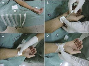Placement of the conventional compressive dressing: externalization of the sheath is started after cuff inflation > 10mmHg of the patient's systolic blood pressure (A). Close to the sheath externalization, the dressing is positioned 1cm above the puncture site, applying manual pressure (B). Next, the first compression tape is placed (C), and then the dressing is completed in an “X” (D).