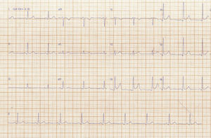Electrocardiogram at admission at the chest pain unit.