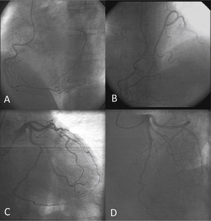 Coronary angiography showing the communication between the right coronary and the left circumflex arteries. Right coronary artery in left anterior oblique view and right anterior oblique cranial view (A and B). Left coronary artery in the right anterior oblique caudal view and left anterior oblique cranial view (C and D).