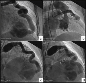 Cardiac catheterization. (A) Selective injection in the left coronary artery. A giant coronary artery fistula draining into the right ventricular apical region with no communication with the remainder of the ventricular cavity can be observed. (B) Right ventriculography showing absence of the apical segment. (C) Temporary balloon occlusion distal to the first diagonal branch and contrast injection through the distal opening of the balloon, allowing better visualization of the other branches of the left coronary artery. (D) Late phase of the post-occlusion injection, disclosing absence of contrast in the right ventricular sinus and infundibular regions, and coronary sinus opacification (arrows).