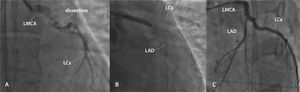 (A) Lesion showing the aspect of spontaneously dissection in the left main coronary artery (LMCA), with minimal flow in the left anterior descending artery (LAD) and left circumflex (LCx) artery. (B) Percutaneous coronary intervention with implantation of a bare-metal stent in the LMCA. (C) Outcome after percutaneous coronary intervention.