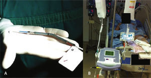 (A) Impella™ ventricular assist device 2.5. (B) Impella™ ventricular assist device 2.5 after being installed.