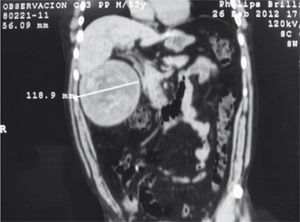 Tomografía de abdomen, corte coronal, con masa hiperdensa en hipocondrio derecho.