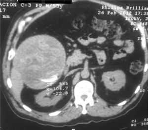Tomografía de abdomen, corte transversal, que muestra cápsula hiperdensa con densidades heterogéneas en su interior.
