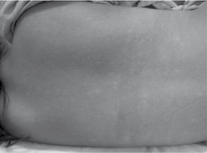 Exantema cutáneo morbiliforme.