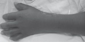 Exantema con tonalidad rojiza intensa y edema de piel.