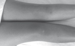 Exantema de predominio en rodillas acompañado de lesiones purpúricas.