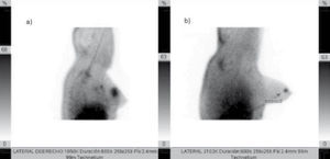 A) Lesión maligna carcinoma canalicular. B) Lesión benigna fibroadenoma. Imágenes tomadas después de 20 minutos de la administración de 99mTc-EDDA/HYNIC-RGD.