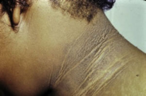 Acantosis Nigricans en cuello. Tomado de: Murphy-Chutorian et al.9.