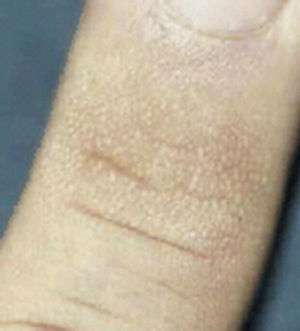 Pápulas de Huntley en región dorsal de articulación interfalángica. Tomado de: Fitzgibbons et al.18.