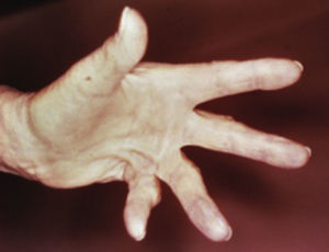 Contractura de Dupuytren. Tomado de: Murphy-Chutorian et al.9.