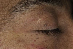 Acrocordones. Tomado de: Fundación escuela para la formación y actualización de DM y nutrición.