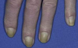 Uñas amarillas. Tomado de: Behm et al.8.