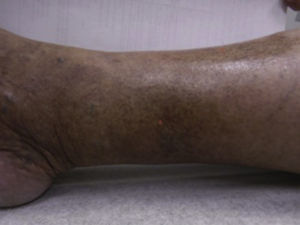 Púrpura pigmentada. Tomado de: Murphy-Chutorian et al.9.