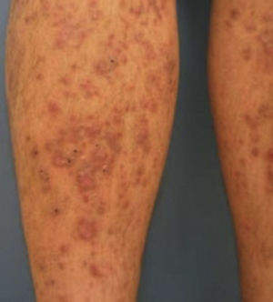 Liquen plano Tomado de: Van Hattem et al.13.