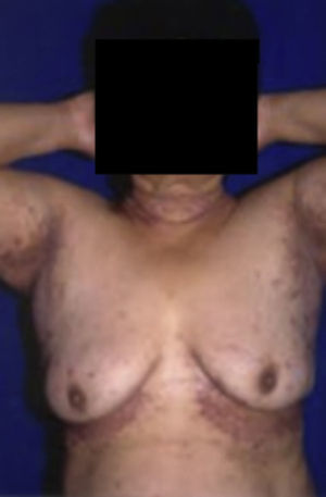 Eritrasma. Tomado de: Santamaría y Barrios10.