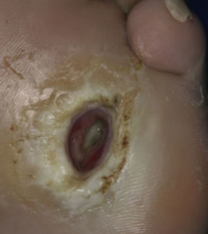 Síndrome de pie diabético (mal perforante plantar). Tomado de: Behm et al.8.