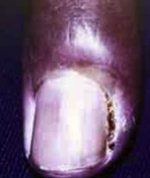 Paroniquia. Tomado de: Santamaría y Barrios10.