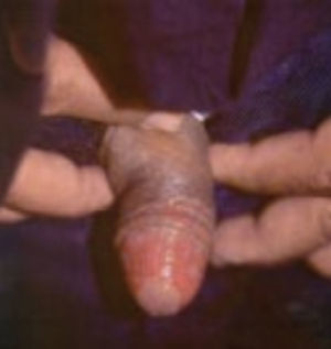 Balanitis por Cándida. Tomado de: Santamaría y Barrios10.