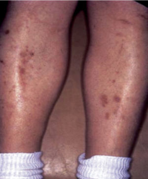 Dermopatía diabética. Tomado de: Chakrabarty et al.28.