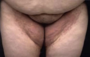 Intertrigo por Cándida. Tomado de: Santamaría y Barrios10.