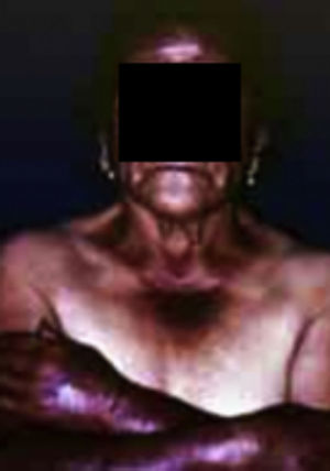 Fotosensibilidad Tomado de: Miracle-López y de la Barreda-Becerril7.