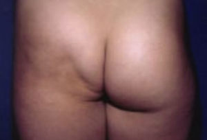 Lipoatrofia. Tomado de: Santamaría y Barrios10.