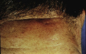 Esclerederma diabeticorum. Tomado de: Murphy-Chutorian et al.9.