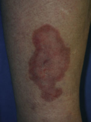 Necrobiosis lipoídica diabeticorum. Tomado de: Behm et al.8.