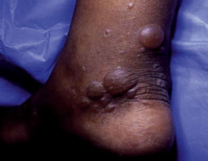 Bullosis diabeticorum. Tomado de: Chakrabarty et al.28.