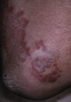 Granuloma anular en extremidad torácica Tomado de: Murphy-Chutorian et al.9.