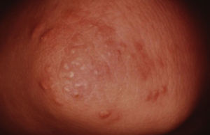 Xantomas eruptivos en el codo. Tomado de: Murphy-Chutorian et al.9.