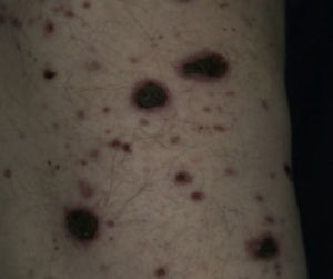 Colagenosis reactiva adquirida perforante Tomado de: Behm et al.8.