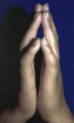 Piel cérea con movilidad articular limitada (signo del predicador) Tomado de: Santamaría y Barrios10.