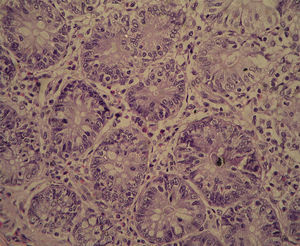 Photomicrograph of colonic tissue stained with HE, showing a pattern of moderate dysplasia (G2 group).
