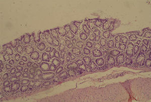Photomicrograph of colonic tissue stained with HE, showing hyperplasia of glandular epithelium (G1 group).