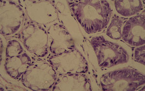Photomicrograph of colonic tissue stained with HE, with mild dysplasia (G1 group).