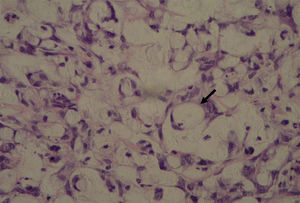 Photomicrograph of colonic tissue stained with HE, featuring carcinoma – the arrow signals a signet ring cell (G1 group).