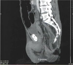 Lipoma as leading point for intussusception at anal verge.