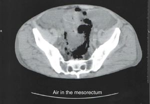 CT scan demonstrated the presence of air in the mesorectum.
